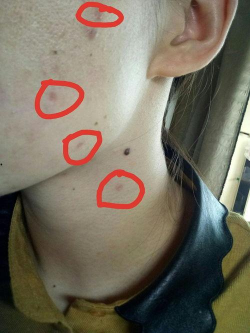 明星点痣经历,揭秘明星点痣经历与美丽蜕变